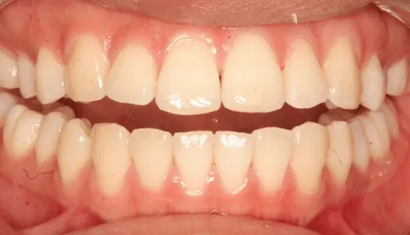 After dental bonding by Dr. Patricia Moezinia, Tribeca