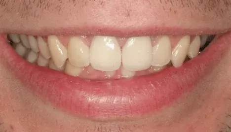 After porcelain dental crown at Empower Your Smile, Tribeca