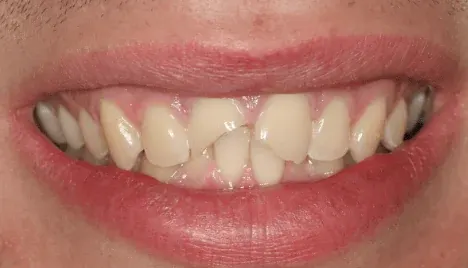 Before dental crown: damaged tooth