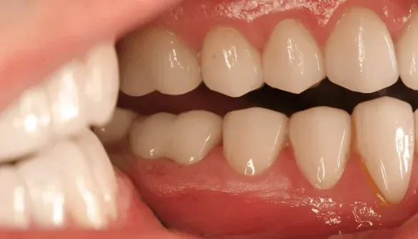 After porcelain dental crown at Empower Your Smile, Tribeca