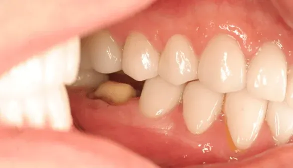 Before dental crown: damaged tooth