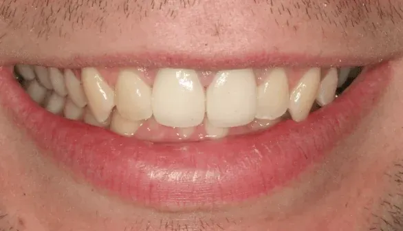 After porcelain dental crown at Empower Your Smile, Tribeca