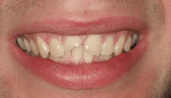 Before dental crown: damaged tooth