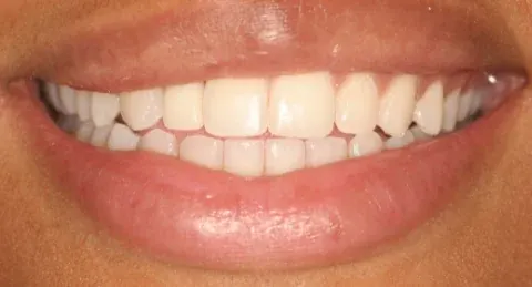 After dental implant restoration at Empower Your Smile, Tribeca