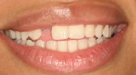 Before dental implant: missing tooth