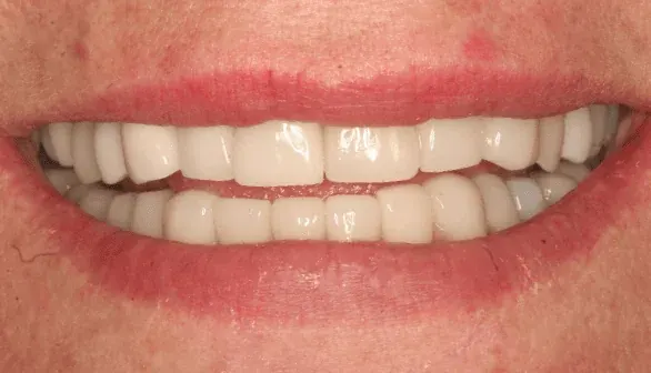 After dental implant restoration at Empower Your Smile, Tribeca