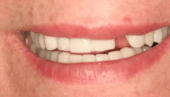 Before dental implant: missing tooth
