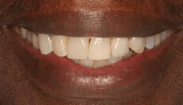After dental implant restoration at Empower Your Smile, Tribeca