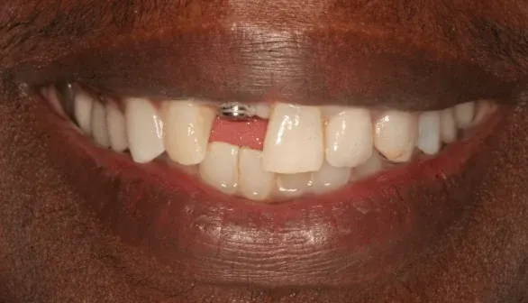 Before dental implant: missing tooth
