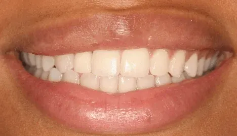 After dental implant restoration at Empower Your Smile, Tribeca
