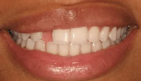 Before dental implant: missing tooth