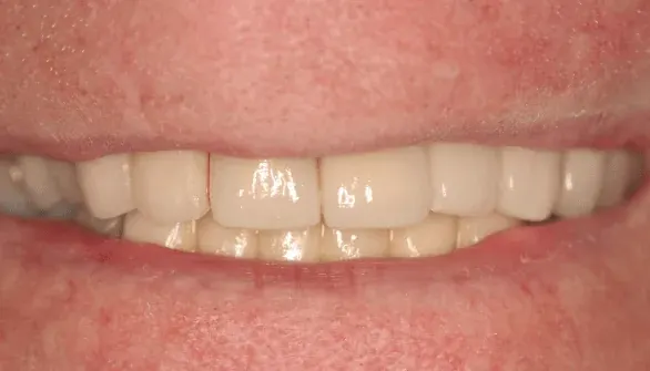 After dental implant restoration at Empower Your Smile, Tribeca