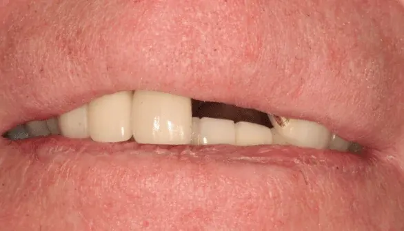 Before dental implant: missing tooth