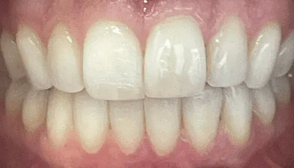 After Invisalign treatment at Empower Your Smile, Tribeca