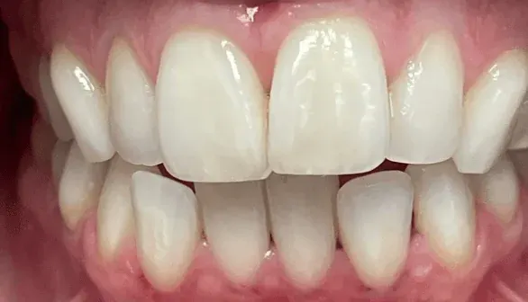 Before Invisalign clear aligner treatment