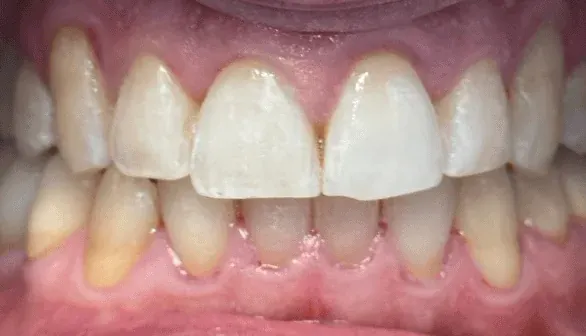 After Invisalign treatment at Empower Your Smile, Tribeca