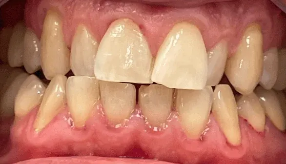 Before Invisalign clear aligner treatment