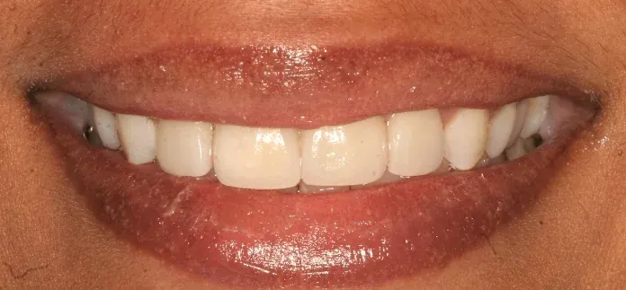 After porcelain veneers by Dr. Patricia Moezinia, Tribeca NYC