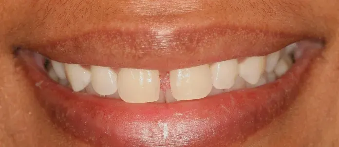 Before porcelain veneers, Tribeca NYC