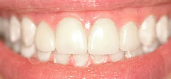 After porcelain veneers by Dr. Patricia Moezinia, Tribeca NYC