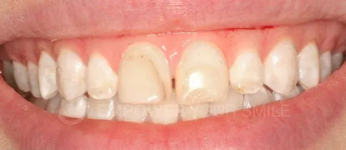 Before porcelain veneers, Tribeca NYC