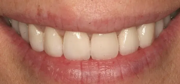 After smile makeover by Dr. Patricia Moezinia, Tribeca NYC