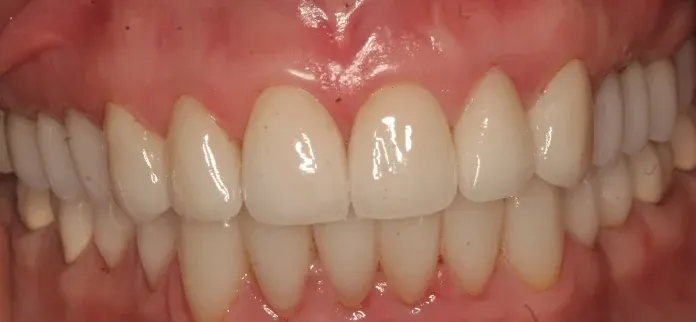 After smile makeover by Dr. Patricia Moezinia, Tribeca NYC