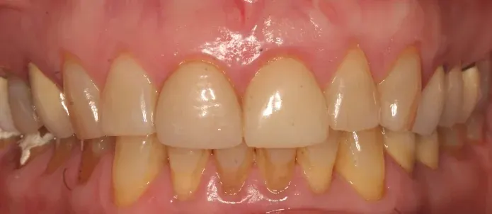 Before smile makeover at Empower Your Smile, Tribeca