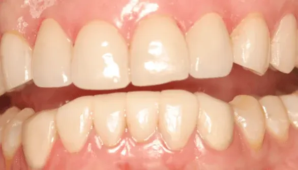 After smile makeover by Dr. Patricia Moezinia, Tribeca NYC