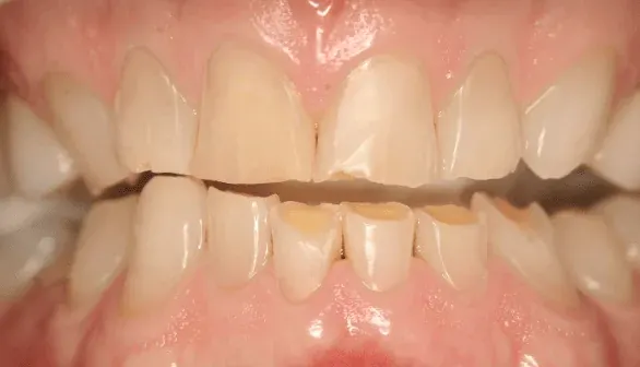 Before smile makeover at Empower Your Smile, Tribeca
