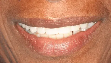After smile makeover by Dr. Patricia Moezinia, Tribeca NYC