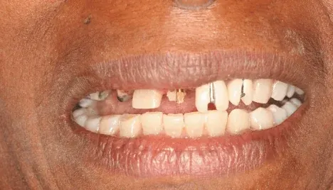 Before smile makeover at Empower Your Smile, Tribeca