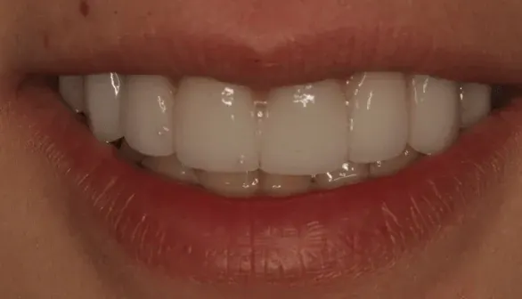 After smile makeover by Dr. Patricia Moezinia, Tribeca NYC