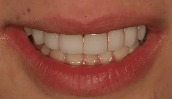 Before smile makeover at Empower Your Smile, Tribeca