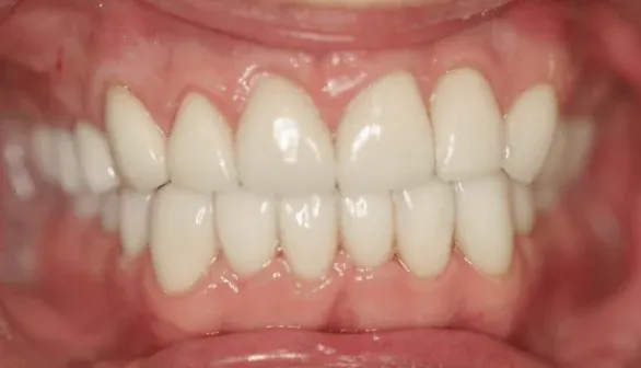 After smile makeover by Dr. Patricia Moezinia, Tribeca NYC