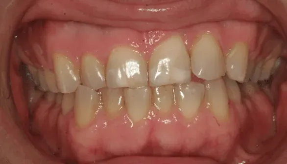 Before smile makeover at Empower Your Smile, Tribeca