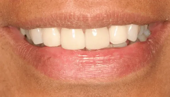 After smile makeover by Dr. Patricia Moezinia, Tribeca NYC