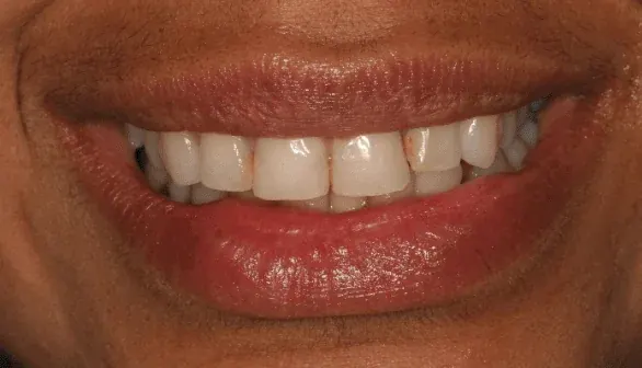 Before smile makeover at Empower Your Smile, Tribeca