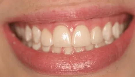 After smile makeover by Dr. Patricia Moezinia, Tribeca NYC