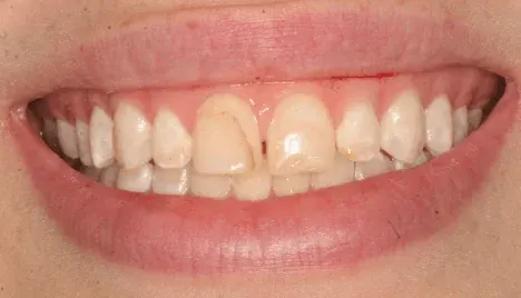 Before smile makeover at Empower Your Smile, Tribeca