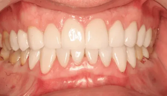 After smile makeover by Dr. Patricia Moezinia, Tribeca NYC