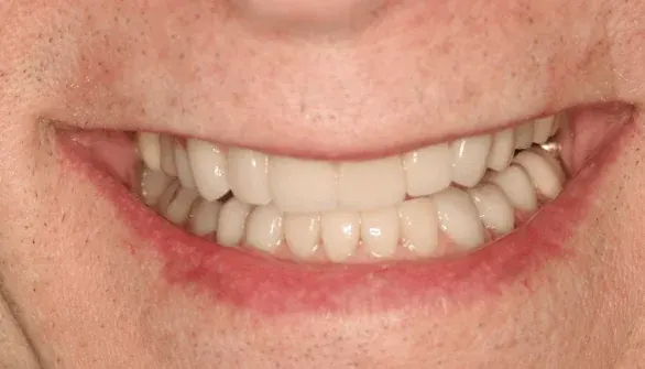 After smile makeover by Dr. Patricia Moezinia, Tribeca NYC