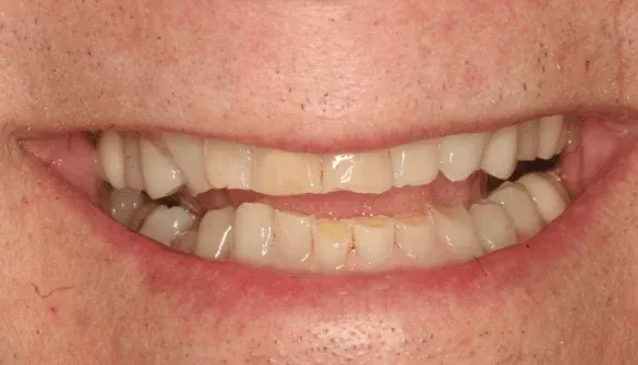 Before smile makeover at Empower Your Smile, Tribeca