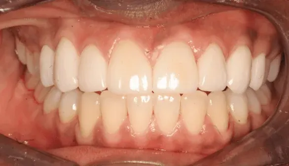 After smile makeover by Dr. Patricia Moezinia, Tribeca NYC