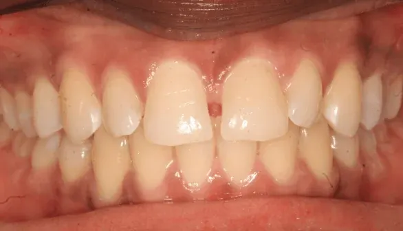 Before smile makeover at Empower Your Smile, Tribeca