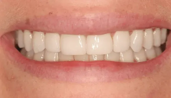 After smile makeover by Dr. Patricia Moezinia, Tribeca NYC