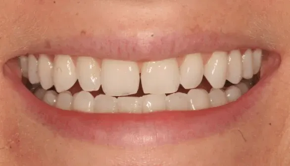 Before smile makeover at Empower Your Smile, Tribeca