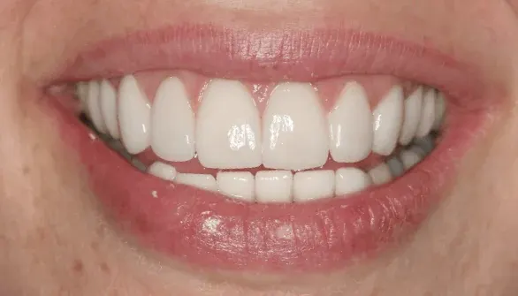 After smile makeover by Dr. Patricia Moezinia, Tribeca NYC