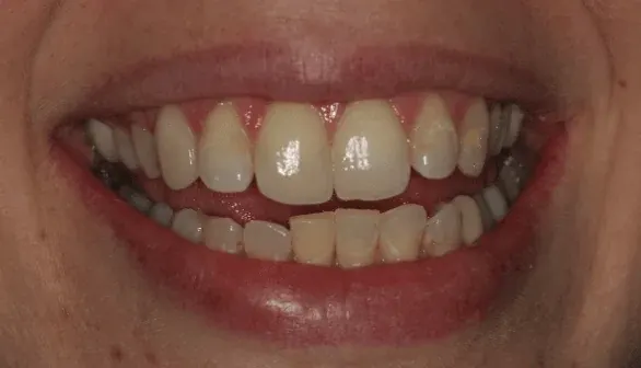 Before smile makeover at Empower Your Smile, Tribeca