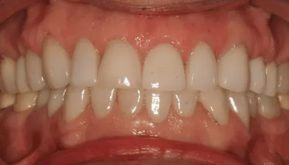 After smile makeover by Dr. Patricia Moezinia, Tribeca NYC